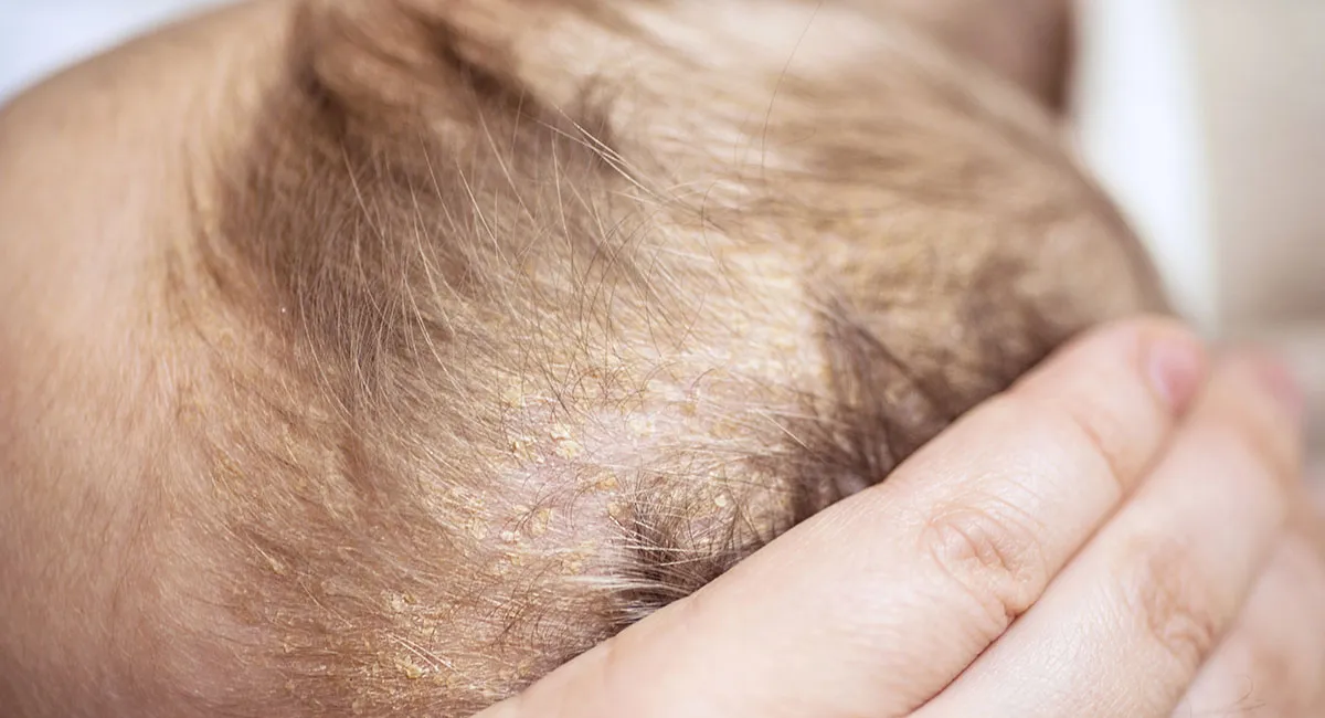 karsta on vauvoilla yleistä