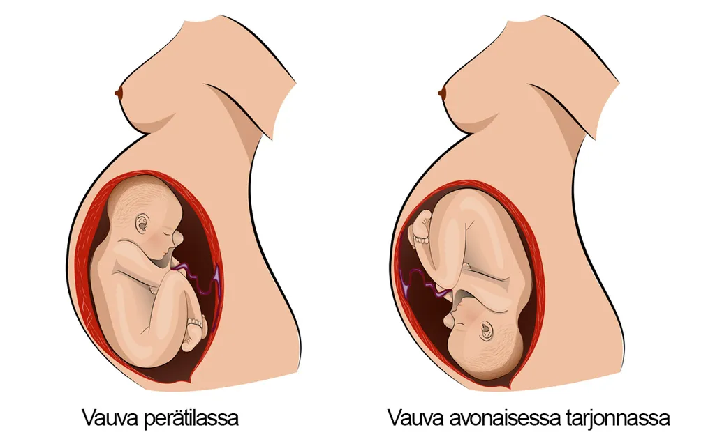 Vauvan asento kohdussa ei aina ole alatiesynnytyksen kannalta optimaalinen.